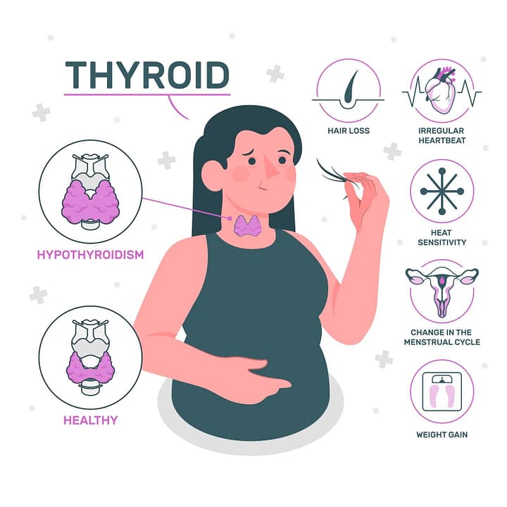 thyroid symptoms in female
